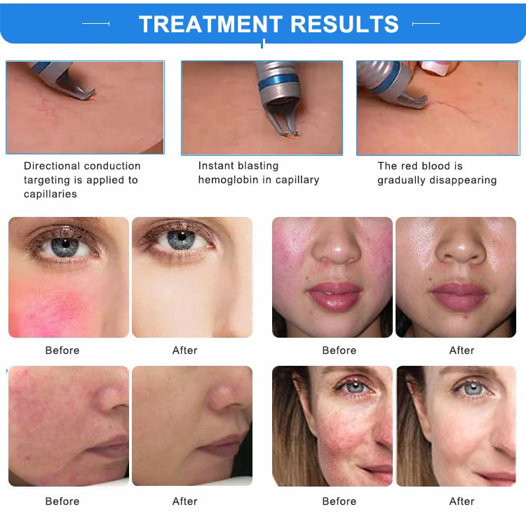 980Nm Laser Diode Vascular Spider Varicose Vein Removal Machine Treatment Fungi Physiotherapy For Nail Lipolisi Commercial Salon