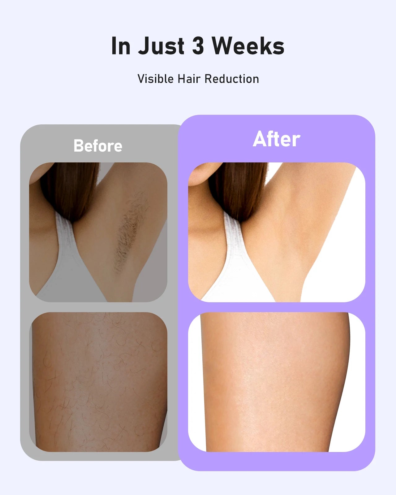 Hair Removal Laser With 9 Energy Levels for Women Permanent Hair Remover 999,900+ Quick Flash Painless IPL Hair Remover Device