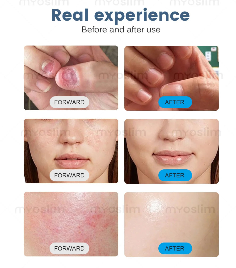 980nm 5 in 1 Laser Diode Vascular Spider Varicose Vein Remover Nail Fungus Treatment Physical Therapy Eczema Removal